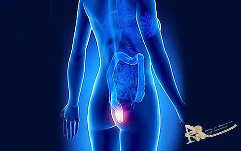 روش های درمان هموروئید