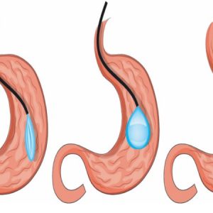 مزایای استفاده از بالون معده