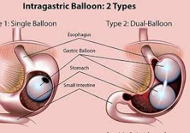 خطرات بالون معده