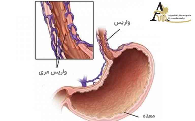 درباره واریس مری و روش های درمانی آن چه اطلاعاتی دارید؟