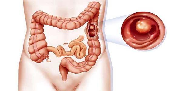 سرطان-روده-بزرگ