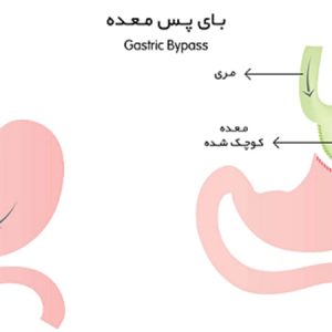 جراحی بای پس معده،عمل لاغری بای پس معده