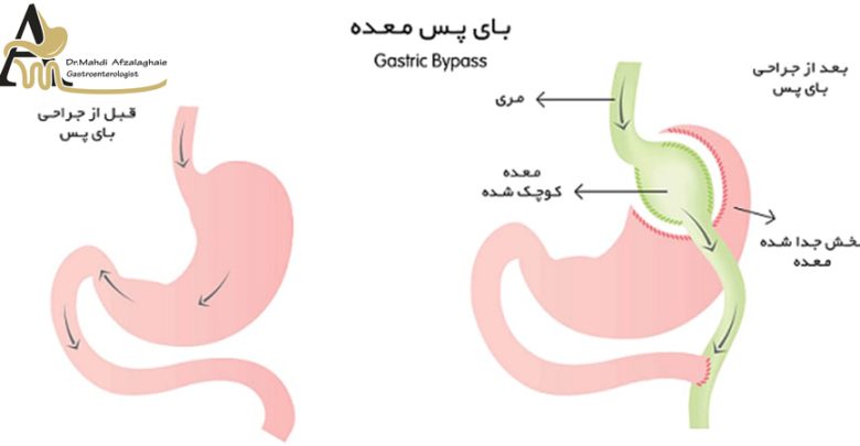 جراحی بای پس معده،عمل لاغری بای پس معده